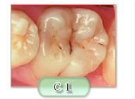 c1の虫歯