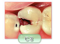 c3の虫歯